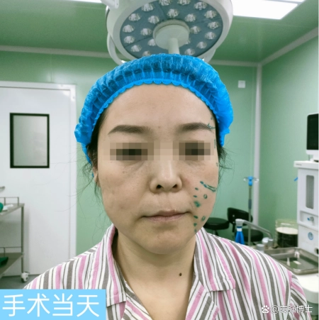 48岁来北京做拉皮手术，术后75天颜值回升，脸小了一圈！丨拉皮北京哪家医院好
